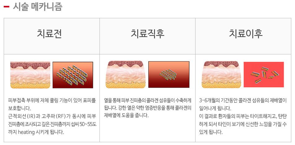 리펌ST